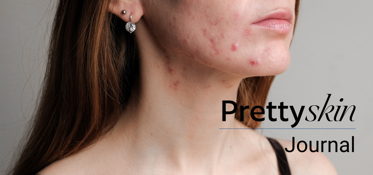 Adult Acne: Why It Happens and How to Calm Breakouts