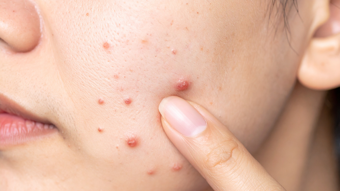 Acne-Prone Skin 101: Causes, Care, and Clear Results
