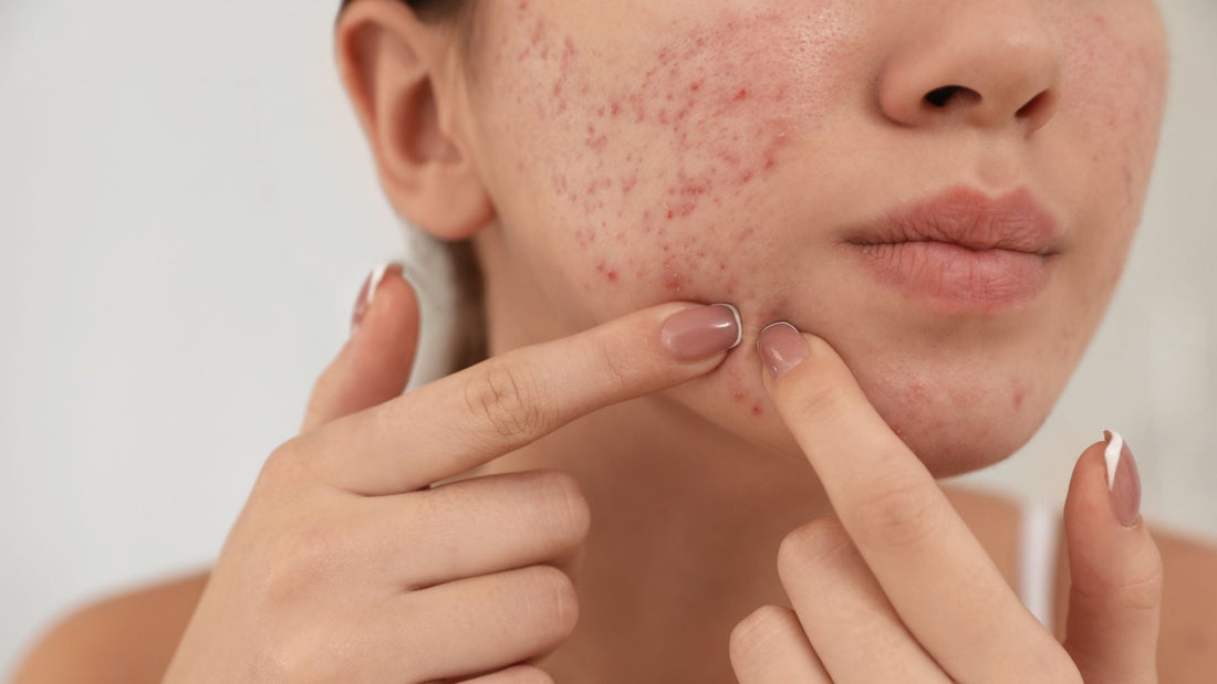 9 Skincare Mistakes That Trigger Acne You Might Be Making